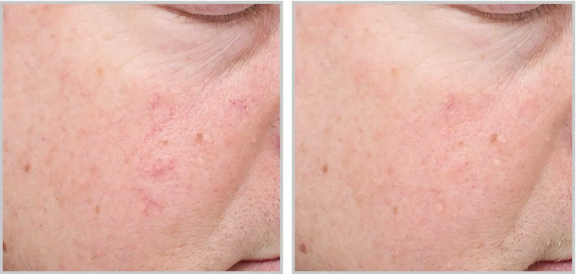 laser treatments tampa