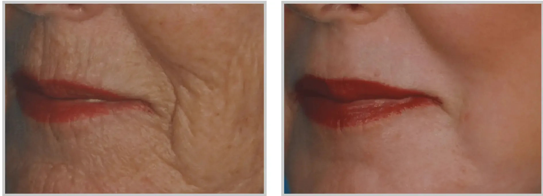 laser resurfacing tampa