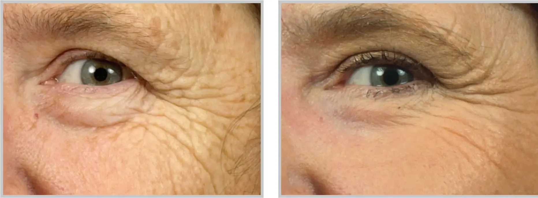 laser resurfacing tampa