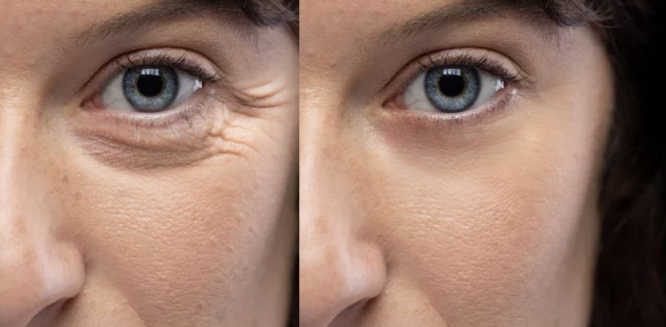 Tampa Botox at Tampa Bay Total Wellness Med Spa Tampa FL