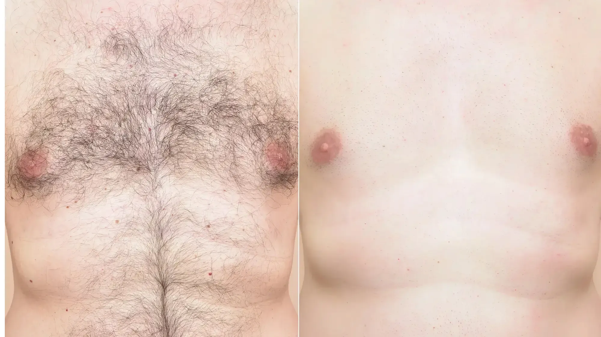 laser hair removal tampa