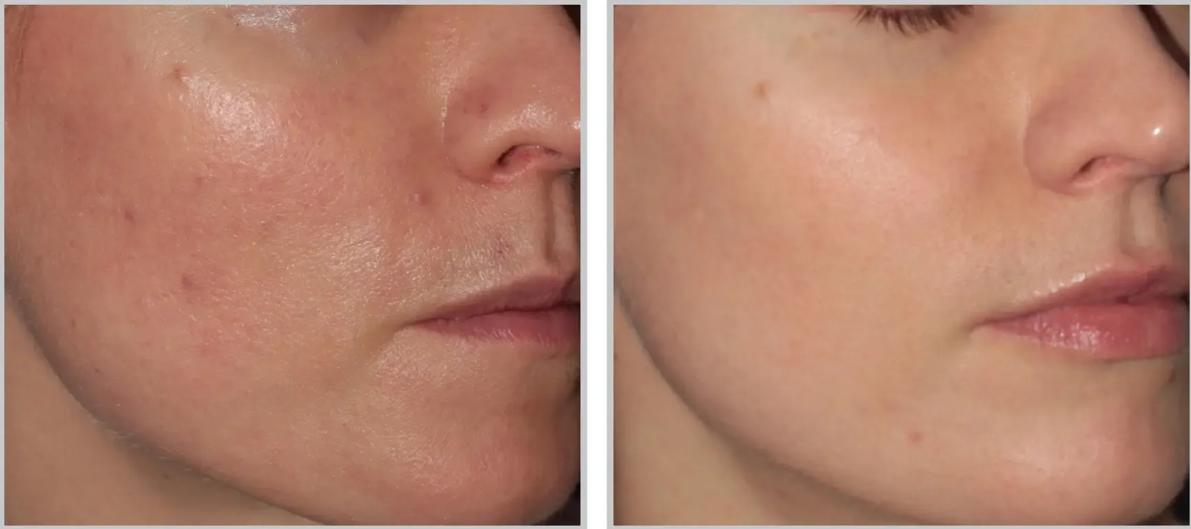 laser treatments tampa