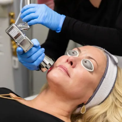 laser treatment for face tampa
