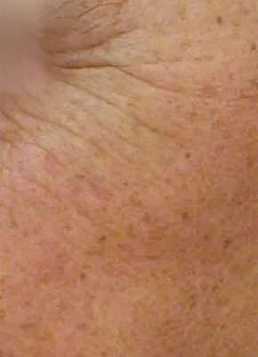 laser skin treatment tampa