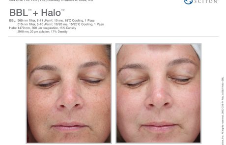 BroadBand Light and Halo Laser Before and After