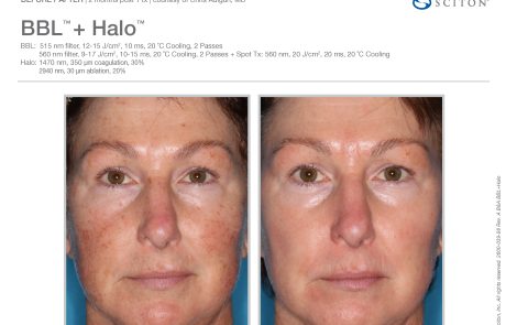 Tampa BroadBand Light and Halo Laser Before and After