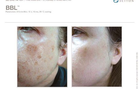 Sun Damage Removal