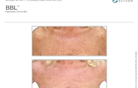 Sun Damage Removal On Chest