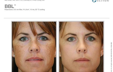 BBL Before and After Face