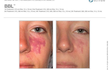 Rosacea Traetment