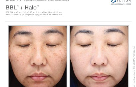BroadBand Light and Halo Laser Before and After