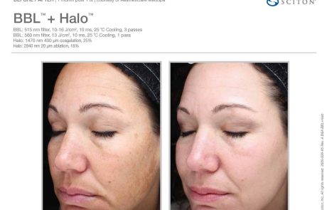 Tampa Bay BroadBand Light and Halo Laser Before and After