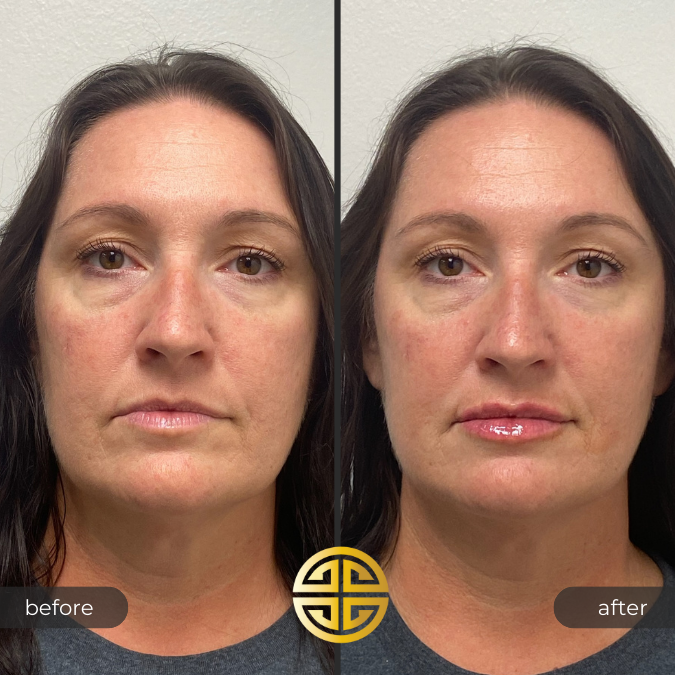 Lip Filler in Tampa Bay Before and After