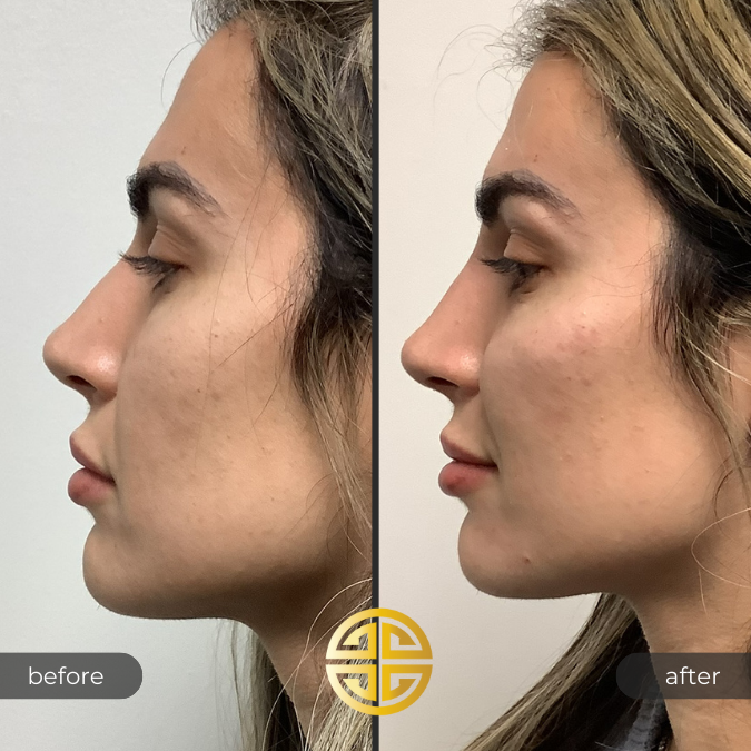 Cheek Filler and Jawline Filler Before and After in Tampa