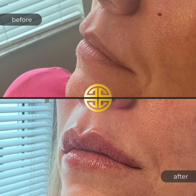 Lip Filler in Tampa Before and After