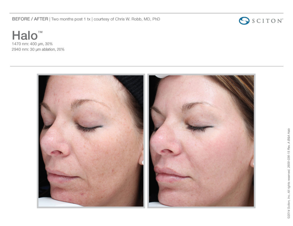 Shrink Pores Tampa