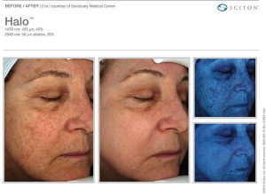 Halo results Tampa Remove sun damage Tampa