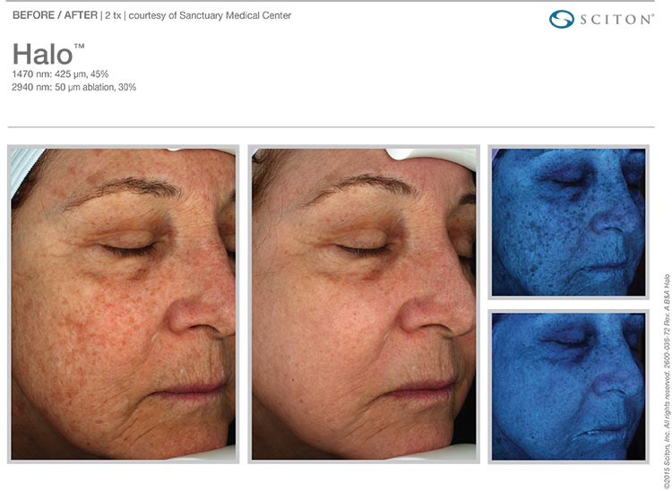 Remove sun damage Tampa