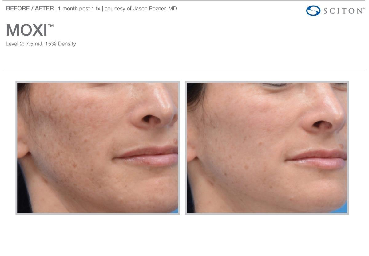 Moxi Laser Before and After Tampa