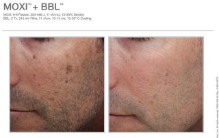 Moxi and BBL Before and After