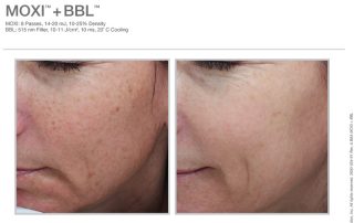 Moxi and BBL Before and After