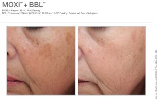 Moxi and BBL Before and After
