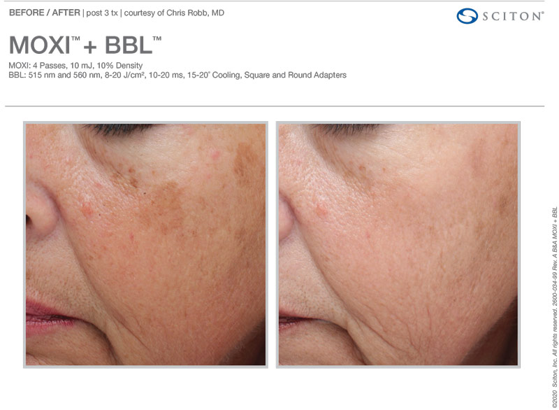 Moxi and BBL Before and After