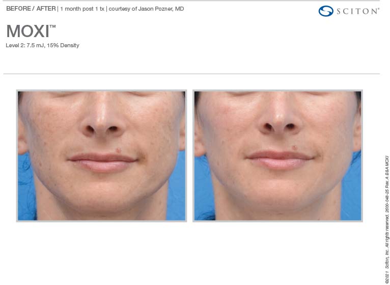 Moxi Laser Before and After Tampa Moxi Laser Before and After Tampa