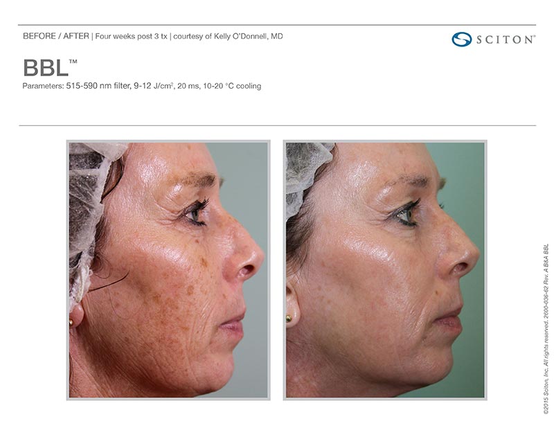 BroadBand Light Therapy Before and After