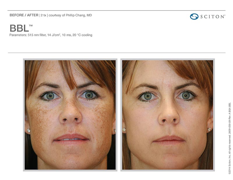 BroadBand Light Therapy Before and After