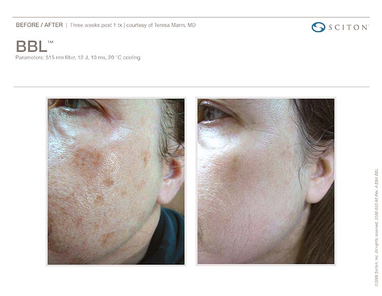 BroadBand Light Therapy Before and After