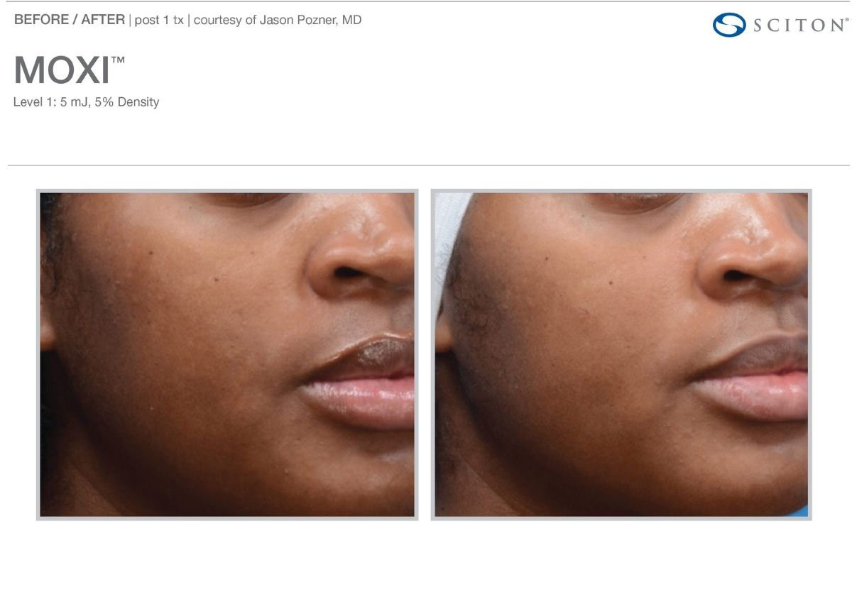 Moxi Laser Before and After