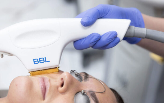 Tampa BBL Hero Laser Treatment Tampa Bay Total Wellness Med Spa Tampa FL