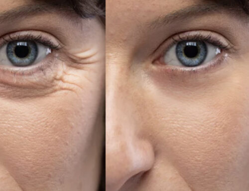 Tampa Botox: Expert Guide to Botox in Tampa Bay