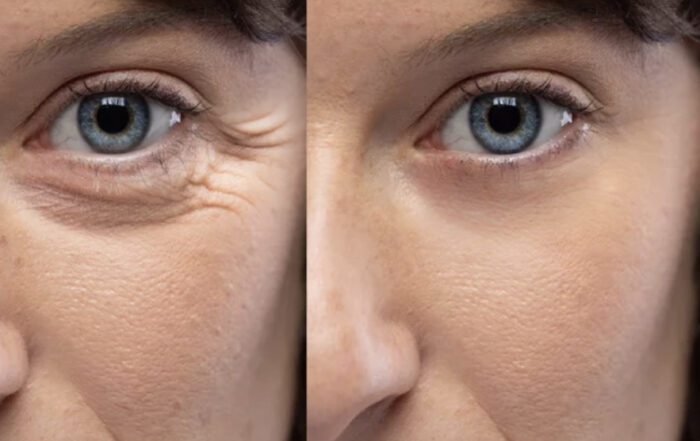 Tampa Botox at Tampa Bay Total Wellness Med Spa Tampa FL
