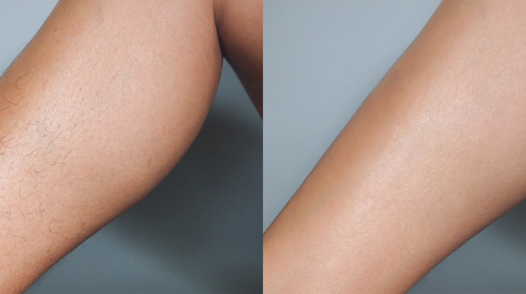 laser hair removal tampa