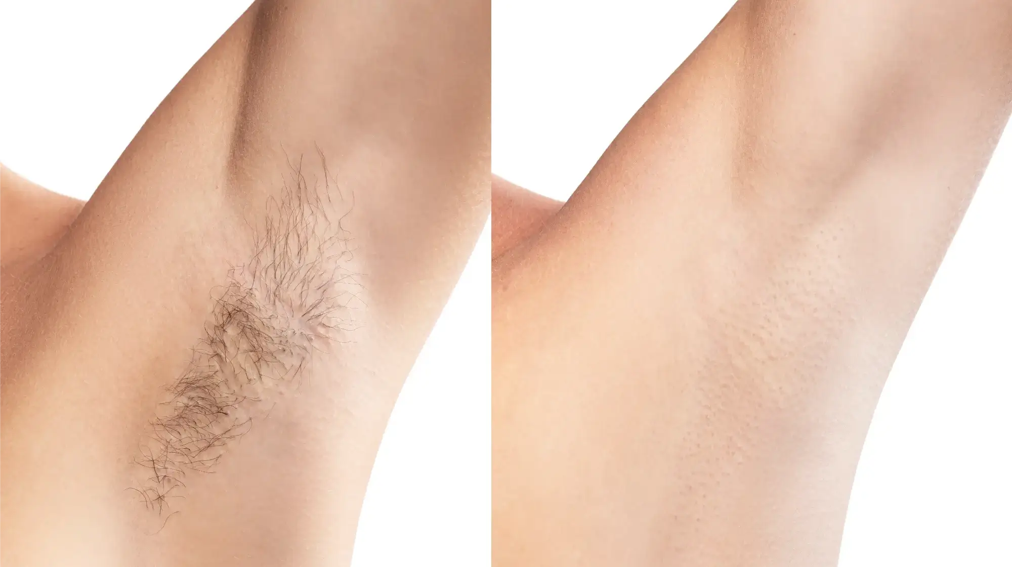 laser hair removal tampa