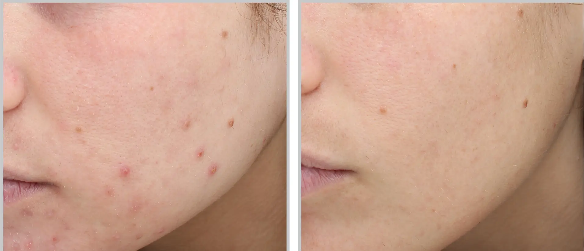 laser treatments tampa