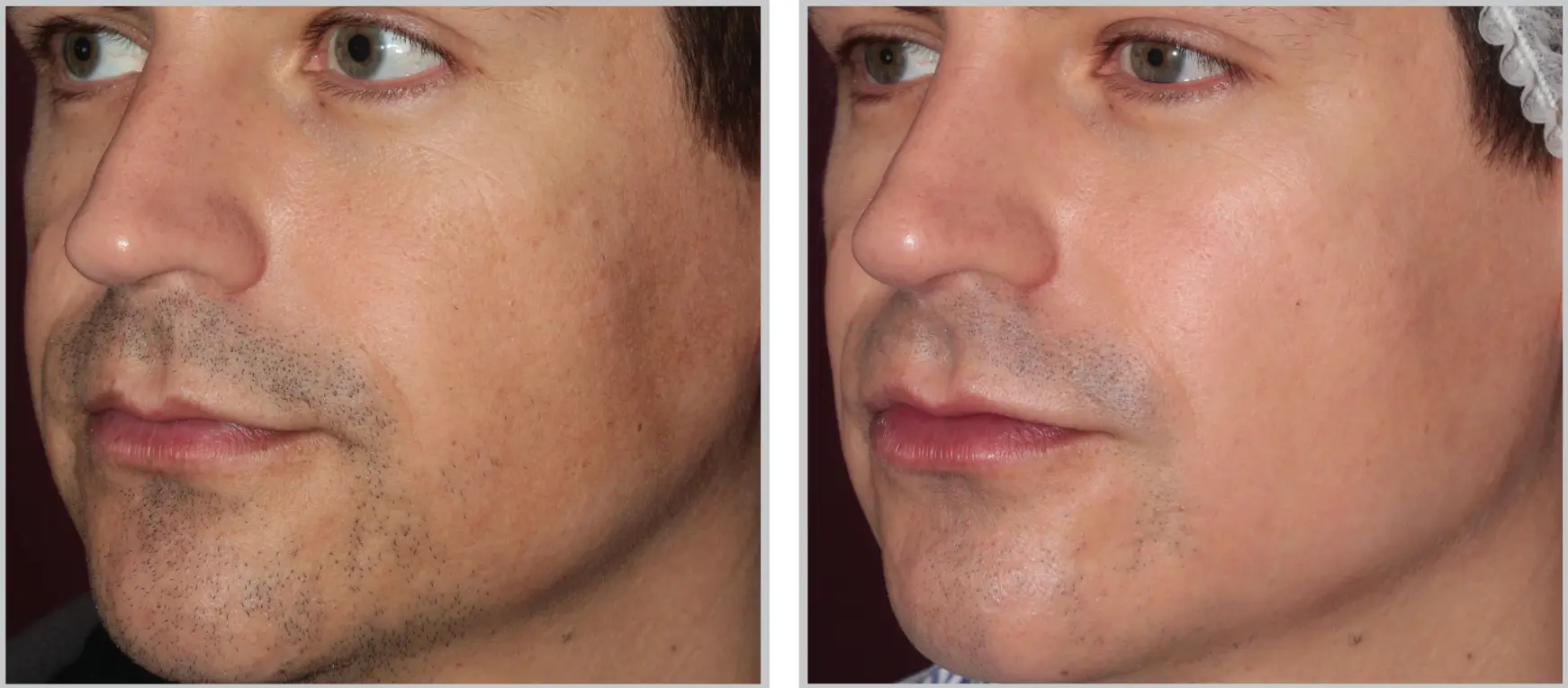 laser treatment for face tampa