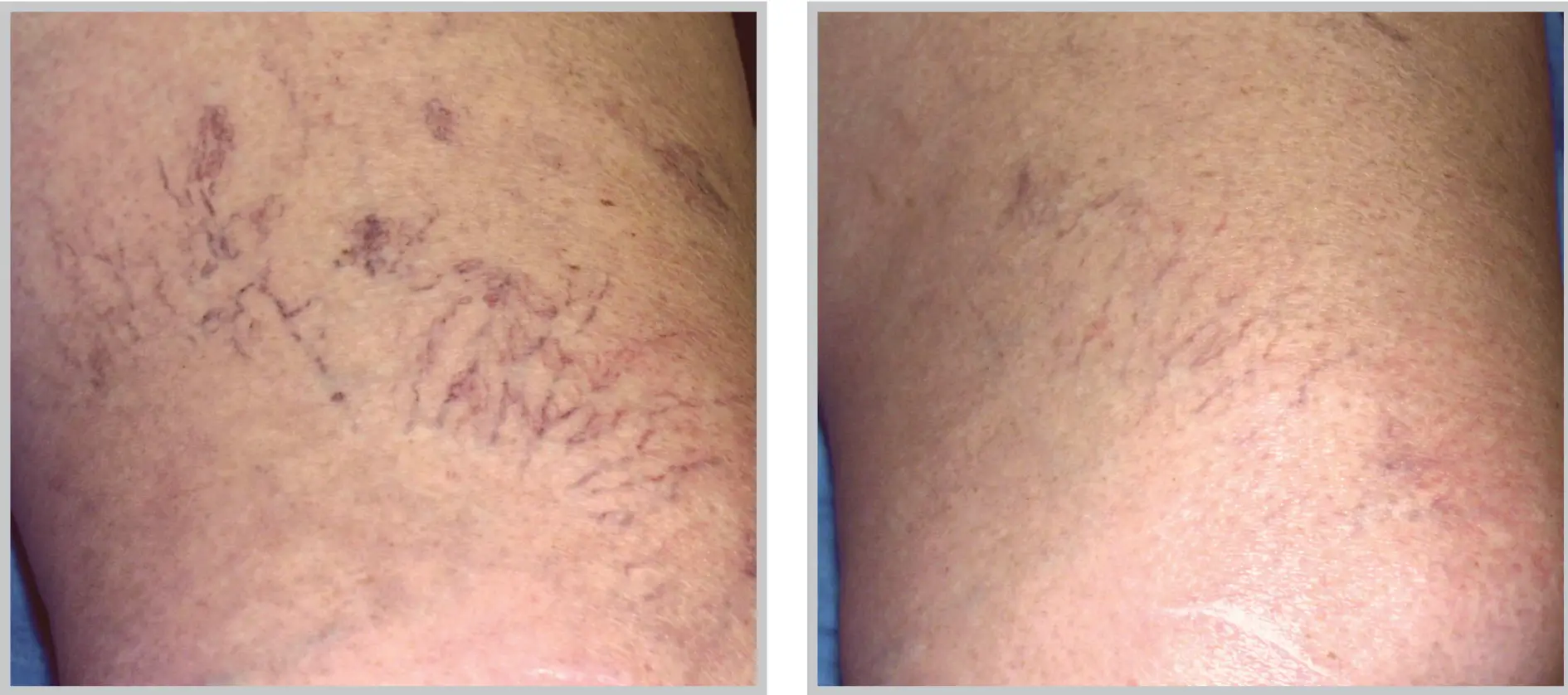 laser treatments tampa