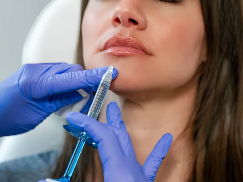 Provider performing a Swedish lip enhancement treatment during a special lip filler event at Tampa Bay Total Wellness