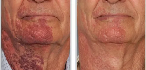 laser treatments tampa