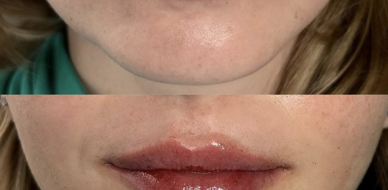 Swedish Lips vs. Traditional Lip Filler Tampa