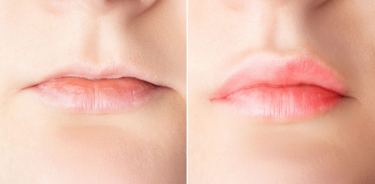 Lip Filler Migration Tampa | What Causes It?