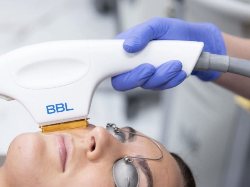 Tampa BBL Hero Laser Treatment Tampa Bay Total Wellness Med Spa Tampa FL