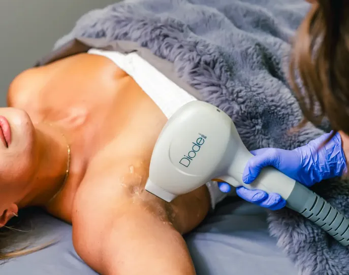 laser hair removal tampa