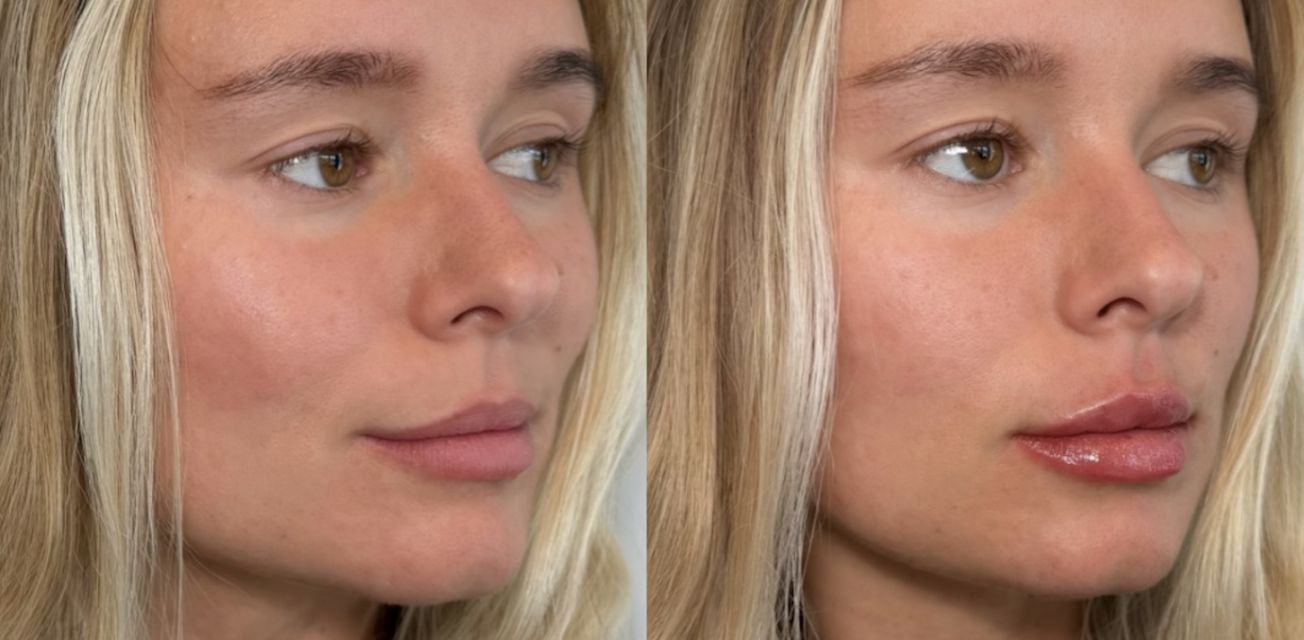 What Are Swedish Lips, and Why Are They Trending in Tampa?
