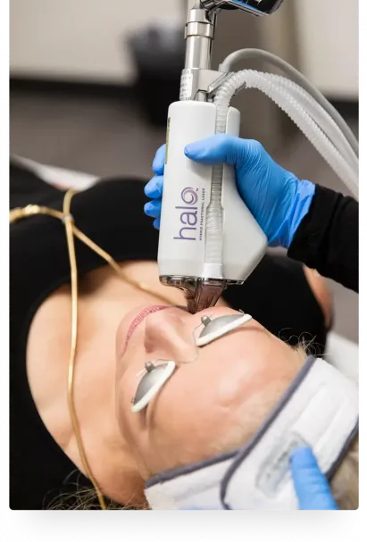 HALO® Laser Treatment in Tampa