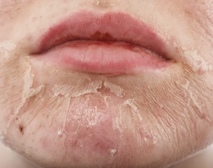 Chemical VI Peel Tampa