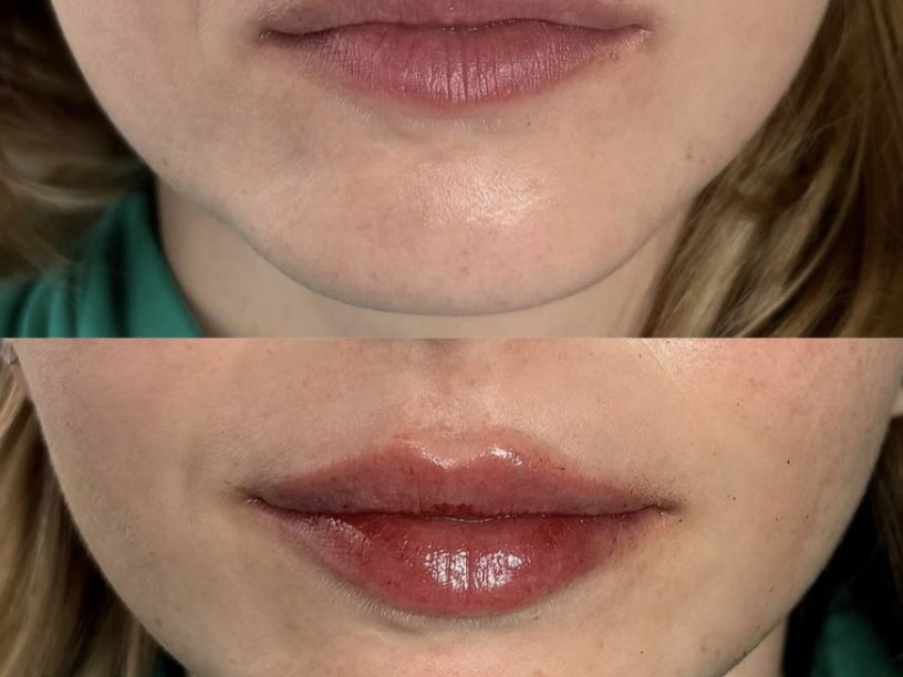 Swedish Lips vs. Traditional Lip Filler Tampa